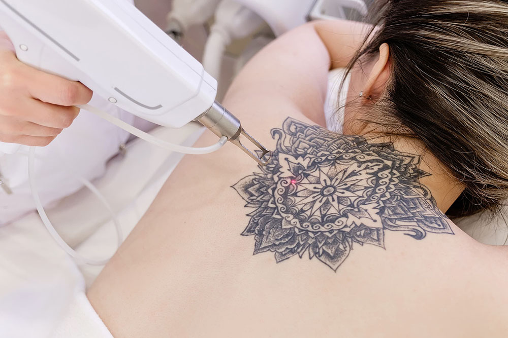 xóa hình xăm bị mờ nét bằng laser